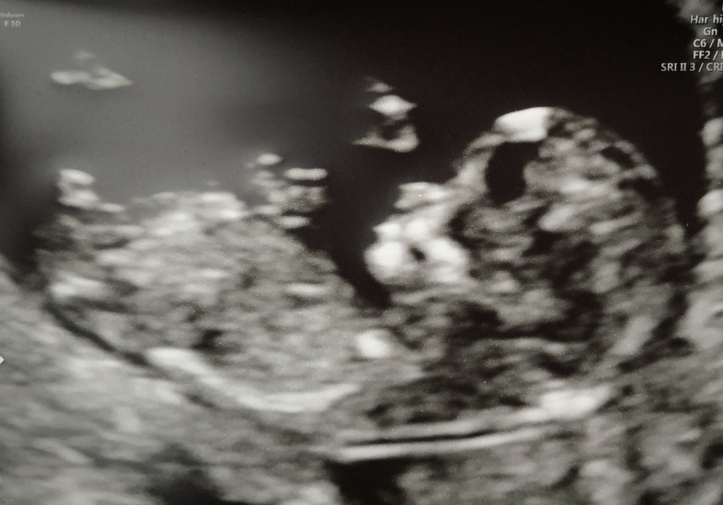 12 week scan, baby is much more visible and has an obvious head and body