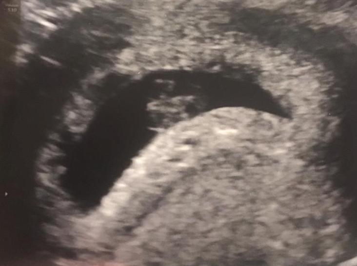 8-week scan, baby is barely visible in a sac of amniotic fluid